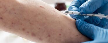 Nova variante da mpox é mais letal, diz infectologista