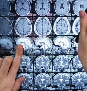 Neurocirurgião esclarece dúvidas sobre tumor cerebral