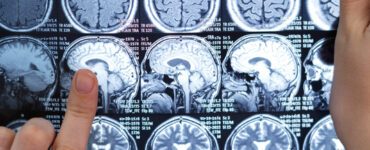 Neurocirurgião esclarece dúvidas sobre tumor cerebral