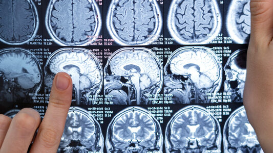 Neurocirurgião esclarece dúvidas sobre tumor cerebral