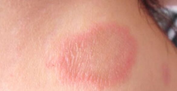 Hanseníase no Brasil é epidemia silenciosa