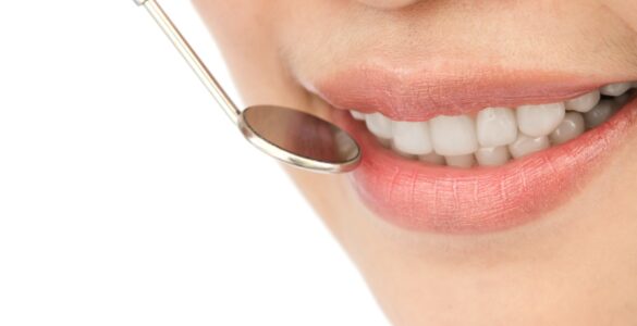 Exagerar no clareamento pode prejudicar os dentes