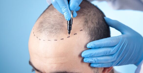 Técnica FUE otimiza resultados do transplante capilar