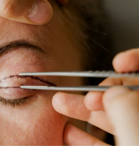 Blefaroplastia: procedimento que rejuvenesce o olhar