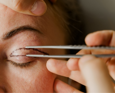 Blefaroplastia: procedimento que rejuvenesce o olhar