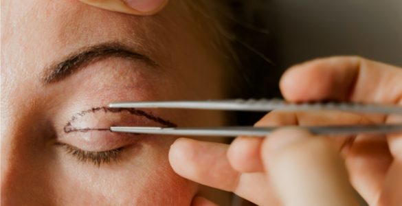 Blefaroplastia: procedimento que rejuvenesce o olhar