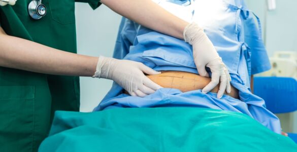 Bariátrica por videolaparoscopia permite melhor recuperação