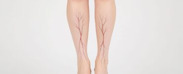 Obesidade e sobrepeso afetam a saúde vascular de brasileiros