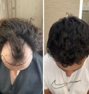 Inovações ajudam a popularizar busca por transplante capilar