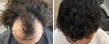 Inovações ajudam a popularizar busca por transplante capilar