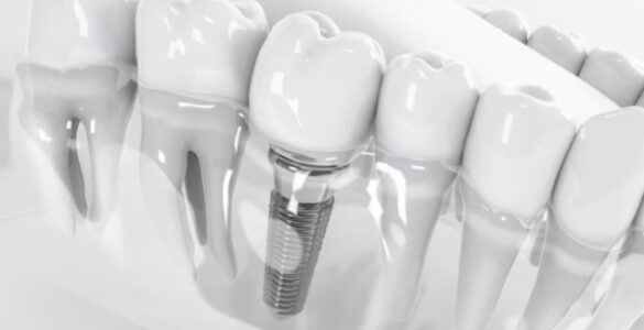 Implante zigomático traz nova alternativa na implantodontia