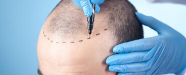 Busca por transplante capilar cresce no Brasil