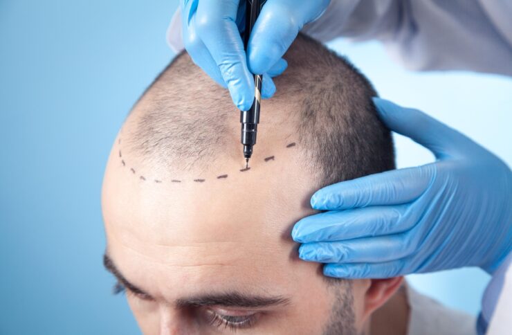 Busca por transplante capilar cresce no Brasil