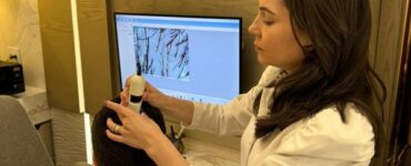 Genética é motivo da queda de cabelo em 80% dos pacientes