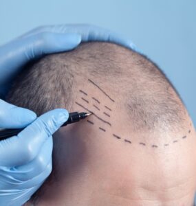Tecnologia visa mais naturalidade em transplante capilares