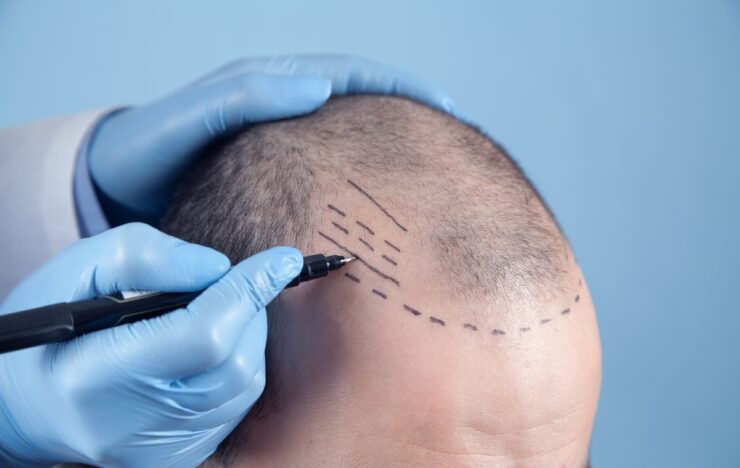 Tecnologia visa mais naturalidade em transplante capilares