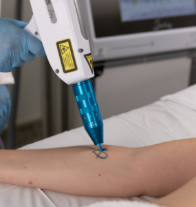 Procura por remoção de tatuagens cresce no Brasil