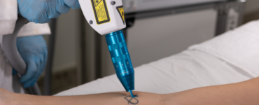 Procura por remoção de tatuagens cresce no Brasil