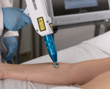 Procura por remoção de tatuagens cresce no Brasil