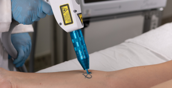 Procura por remoção de tatuagens cresce no Brasil