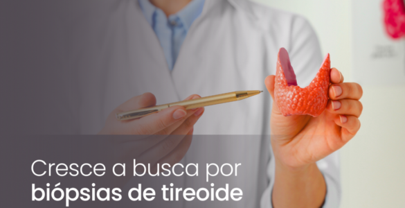 Cresce a busca por biópsias de tireoide no Brasil