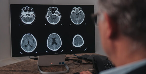 Maio Cinza: mês reforça a conscientização sobre o câncer cerebral