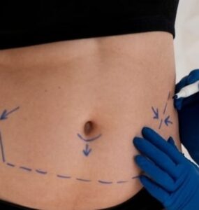 Mini ou abdominoplastia: especialista aponta melhor escolha