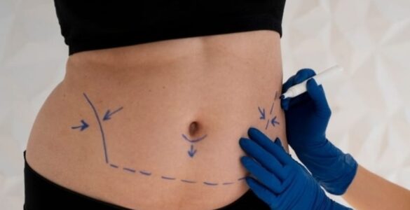 Mini ou abdominoplastia: especialista aponta melhor escolha