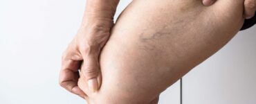 Tratamento de varizes evolui com métodos menos invasivos