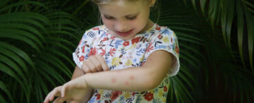 Picada de mosquito pode ser aliviada com cuidados especiais