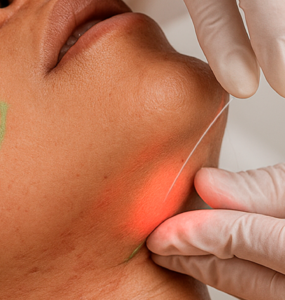 Laser subdérmico surge como alternativa à lipoaspiração
