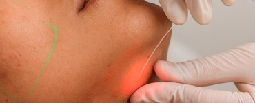 Laser subdérmico surge como alternativa à lipoaspiração