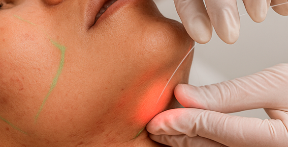 Laser subdérmico surge como alternativa à lipoaspiração