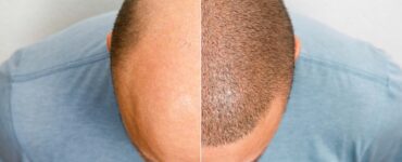 Personalização maximiza efeitos do transplante capilar