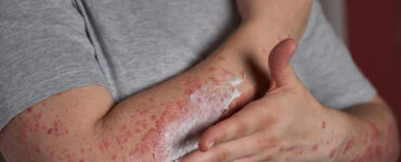 Justiça permite acesso ao omalizumabe para urticária crônica