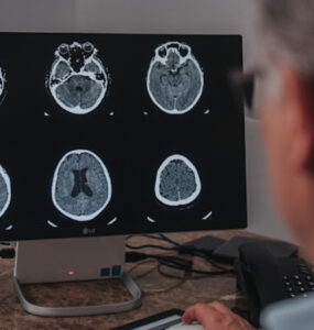 Setembro é o mês de conscientização do aneurisma cerebral
