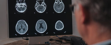 Setembro é o mês de conscientização do aneurisma cerebral