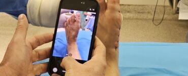Tratamento das joanetes avança com cirurgia pouco invasiva
