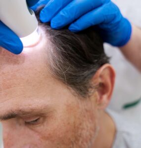 Terapias clínicas não cirúrgicas ativam crescimento capilar