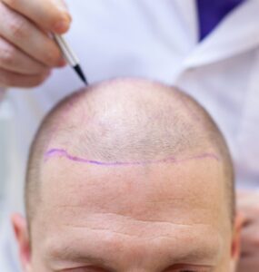 Revisão de transplante capilar exige especialização