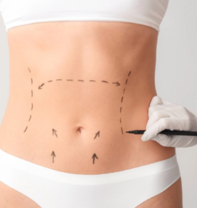 Avanços técnicos ajudam a reduzir cicatrizes cirúrgicas