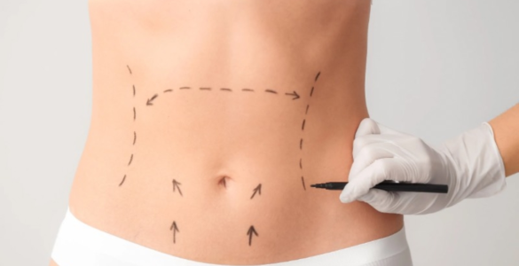 Avanços técnicos ajudam a reduzir cicatrizes cirúrgicas