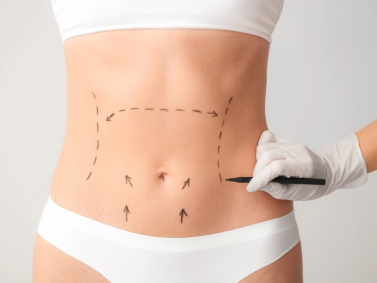 Avanços técnicos ajudam a reduzir cicatrizes cirúrgicas