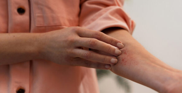 Diagnóstico tardio agrava casos de hidradenite no país