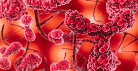 ANS avalia inclusão de tratamento para mielofibrose no rol