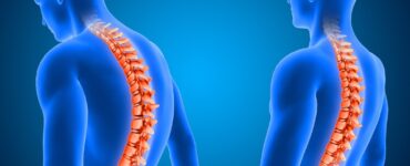 Cirurgia de escoliose é a 1ª com neuronavegação em Uberlândia