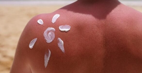 NoSunscreen: movimento viral preocupa especialistas