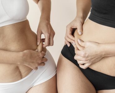 Lipoaspiração exige cuidados médicos rigorosos, alerta especialista