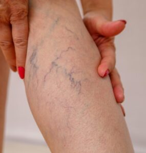 Obesidade e varizes têm relação e exigem atenção médica