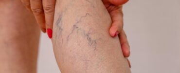 Obesidade e varizes têm relação e exigem atenção médica